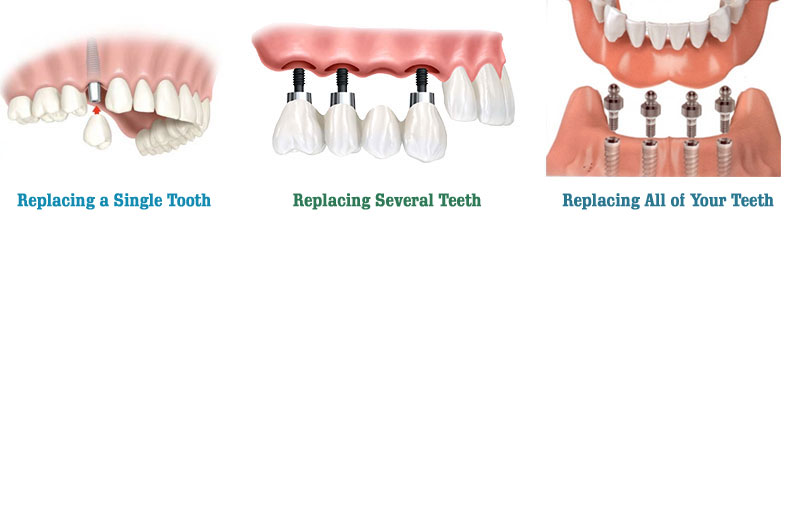 hangi durumlarda implant