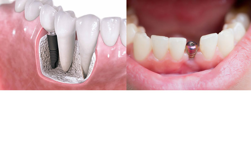 implant